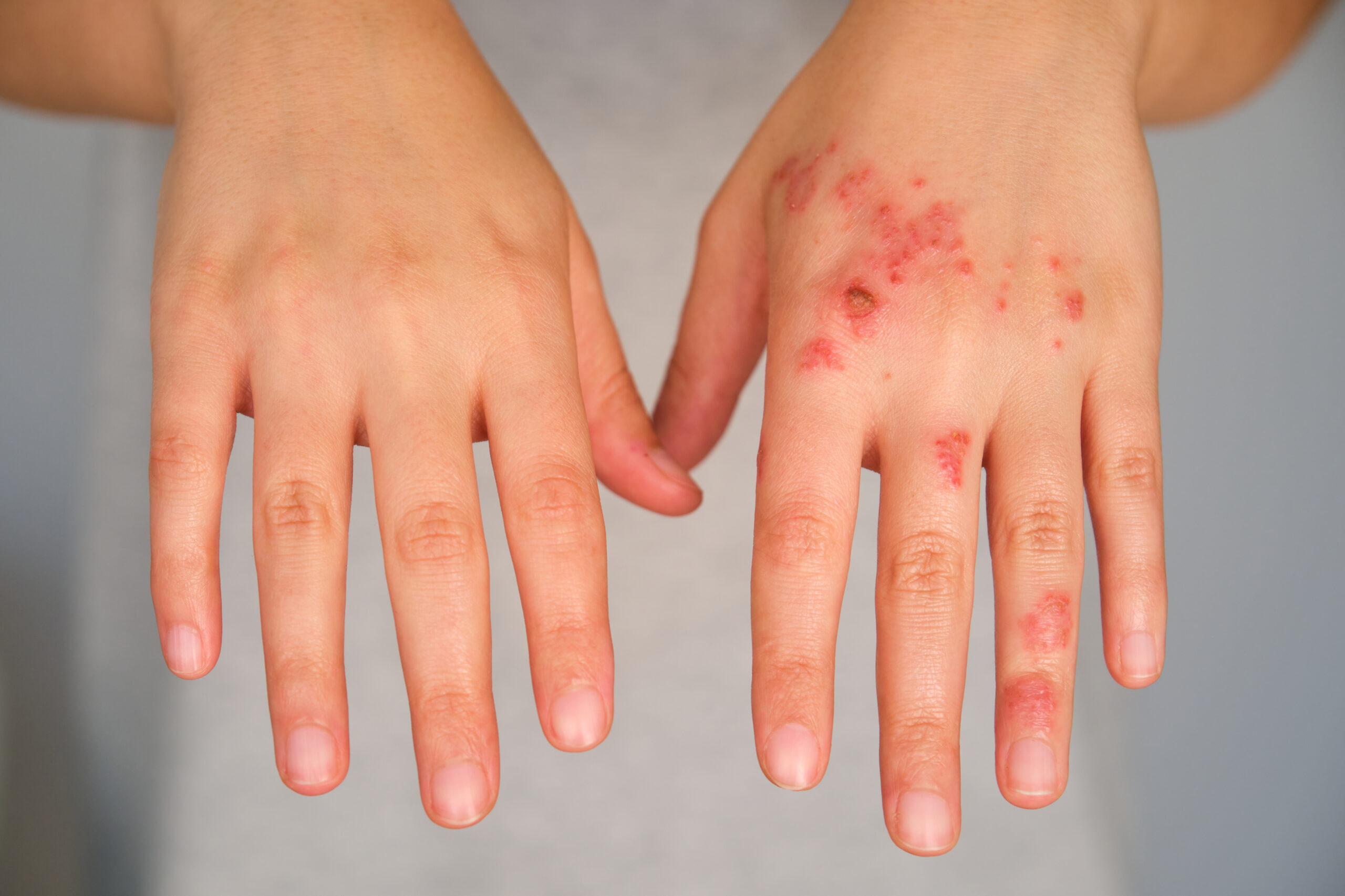 Red and inflamed skin lesions on a child’s hands as a sign of atopic dermatitis